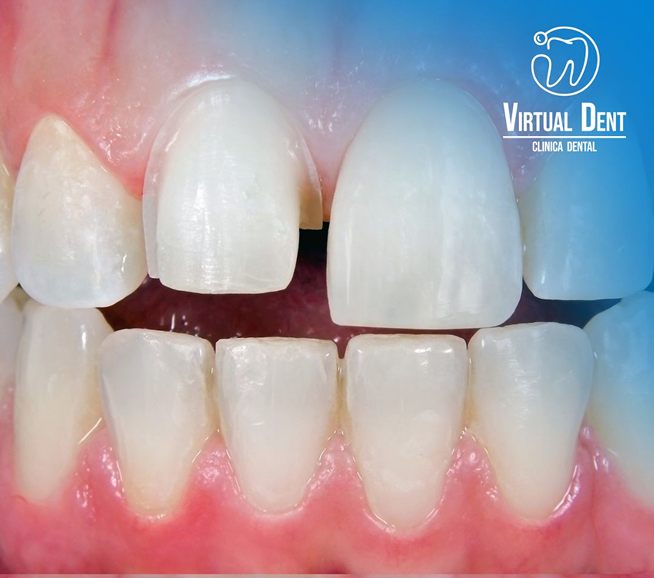 Antes: dientes frontales sin restaurar