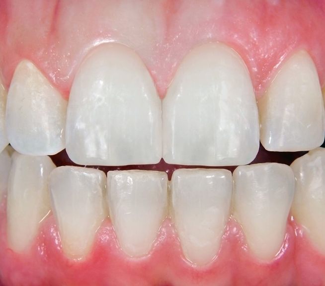 Después: dientes frontales restaurados